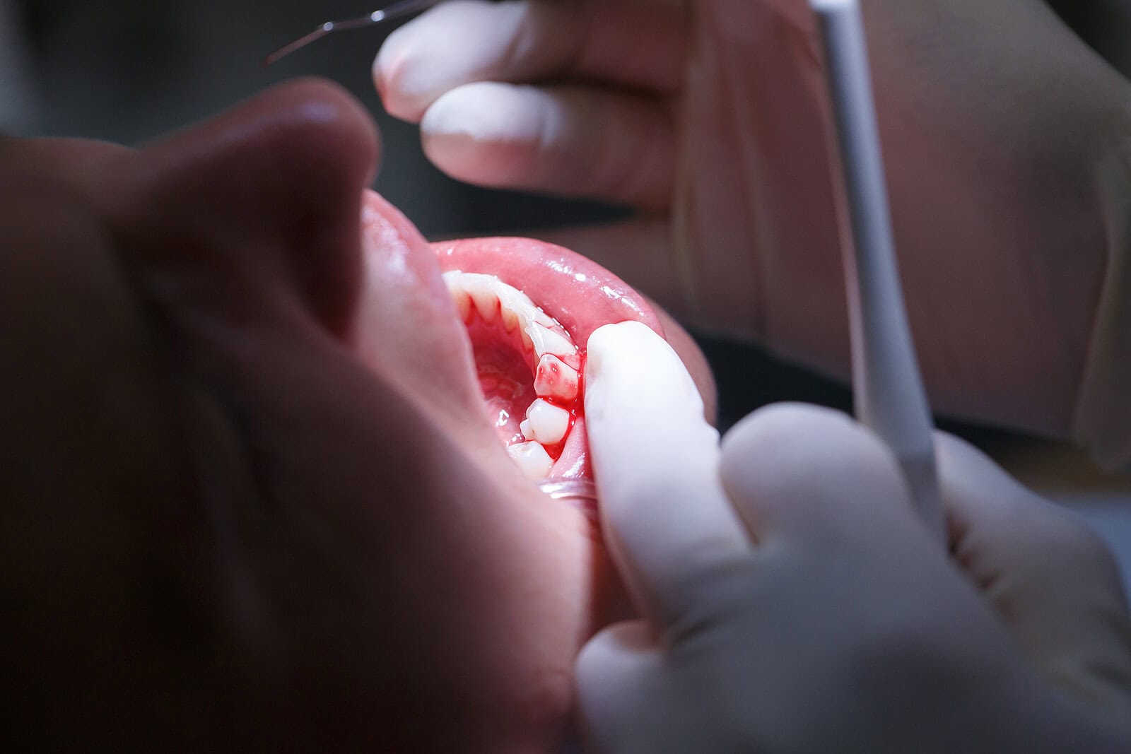 Dental hygienist working on a patient’s teeth