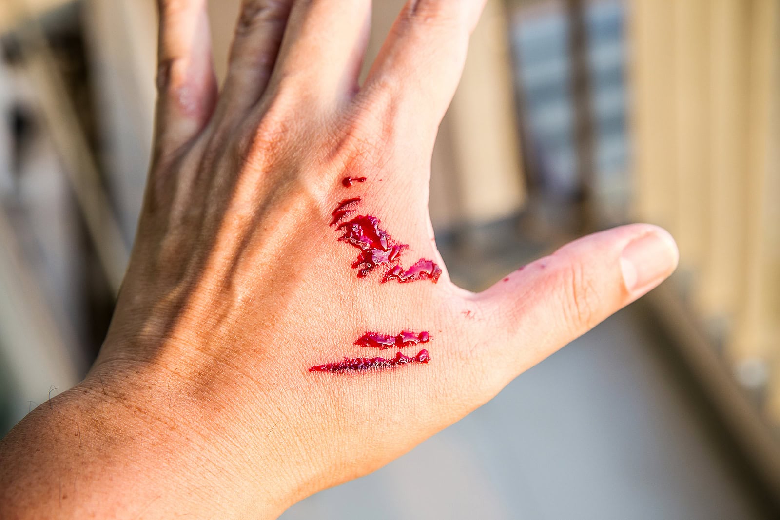 minor dog bite settlement